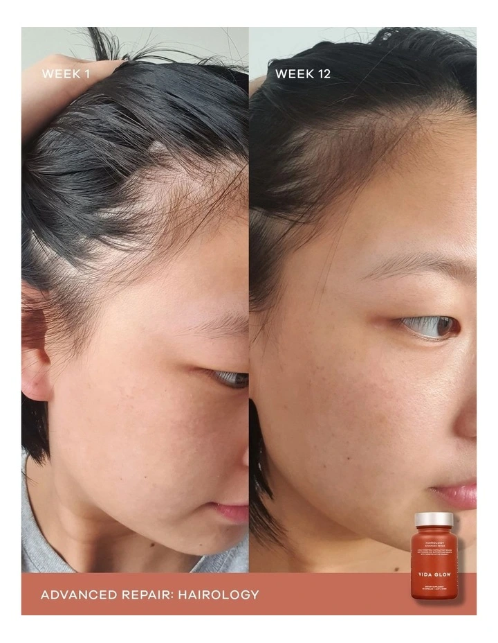 Outlet β€οΈ Vida Glow Hairology Supplement π― 3 Outlet β€οΈ Vida Glow Hairology Supplement π― - Image 3